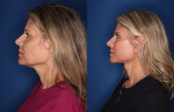Side-by-side profile photos of a woman before and after a cosmetic procedure, showing changes in her jawline, neck, and facial contours against a blue background.