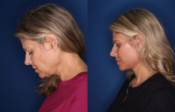 Side-by-side profile photos of a woman before and after a cosmetic procedure, showing reduced loose skin and a more defined jawline.