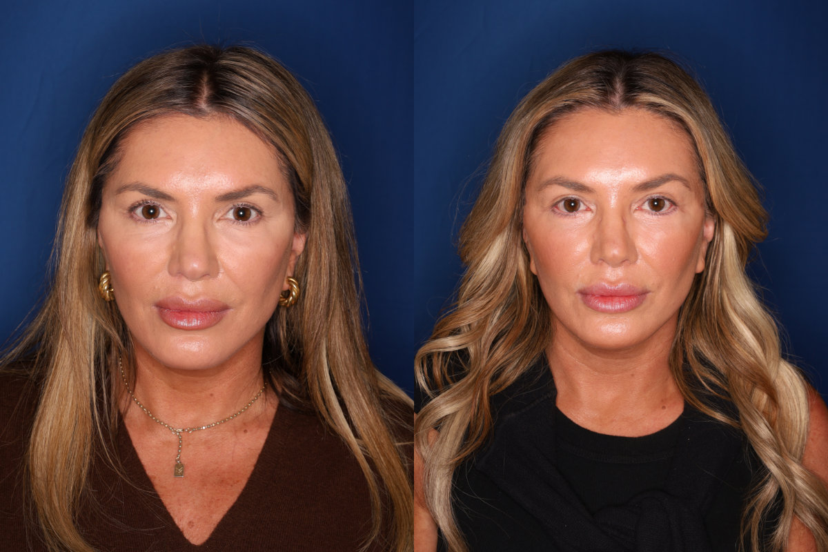 53 year old female 6 months post lower blepharoplasty with fat transposition and lateral temporal brow lift